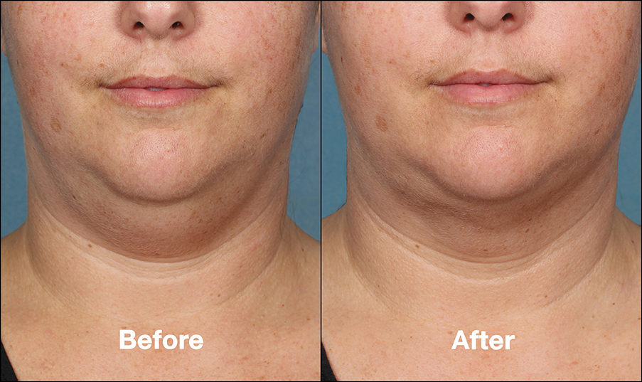 Client before and after Kybella