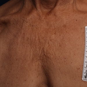 Before ultherapy for chest