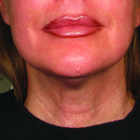 After ultherapy for lower face