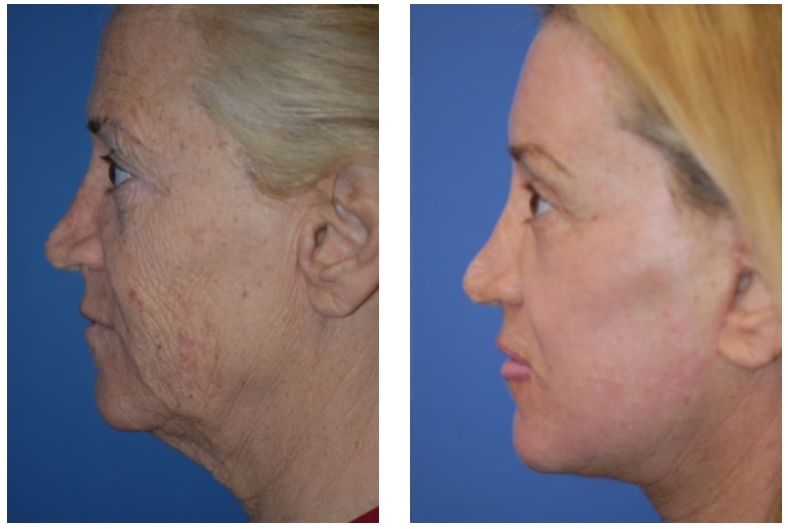 Eyelid surgery before and after