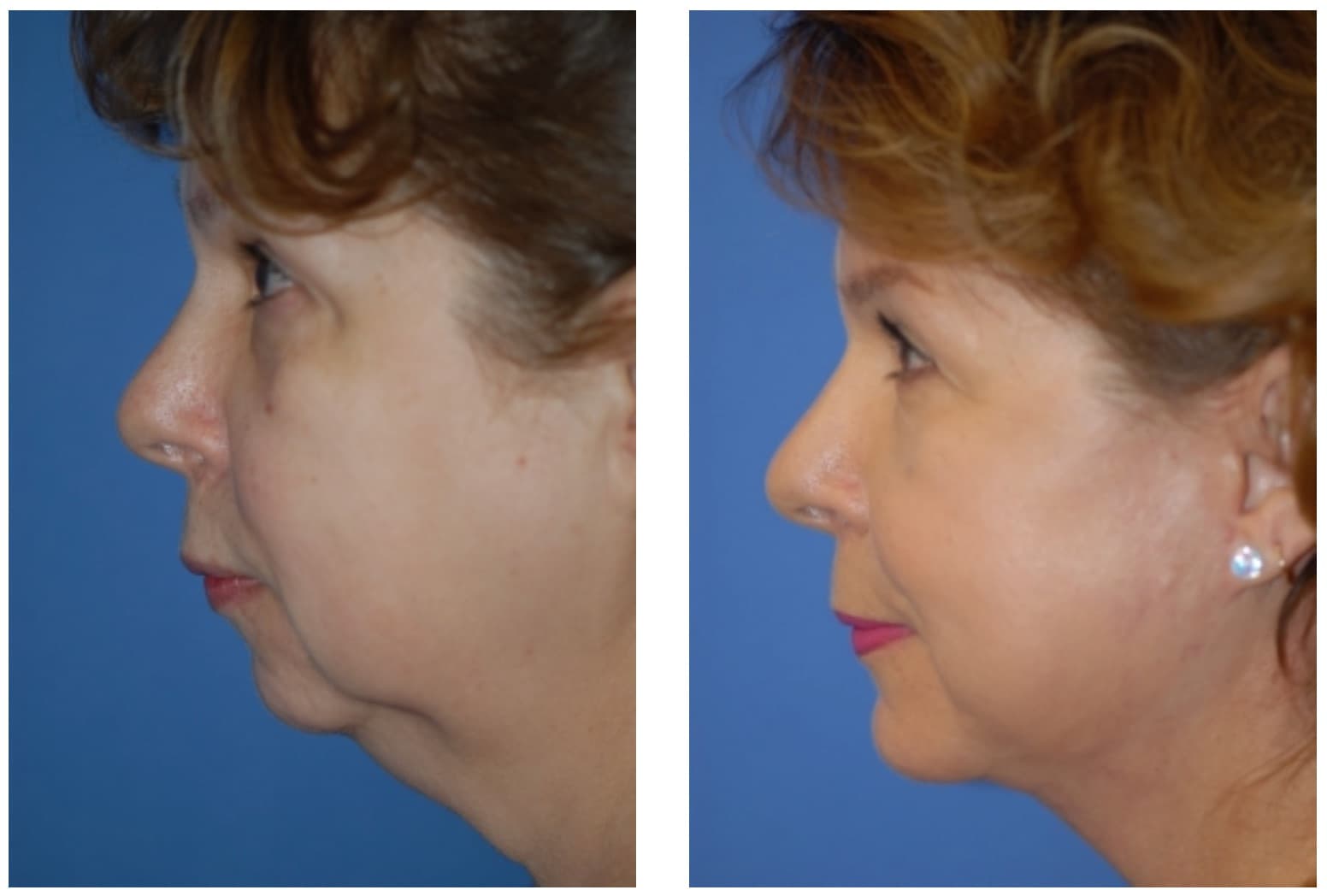 Before and after Eyelid Surgery