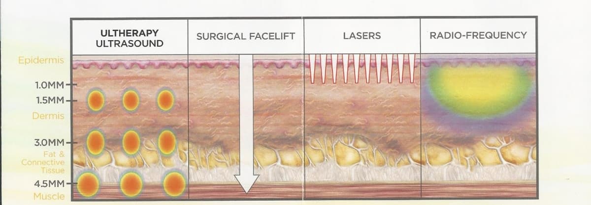 What happens during ultherapy treatment