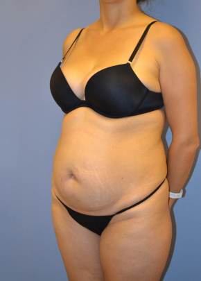 Tummy Tuck NJ