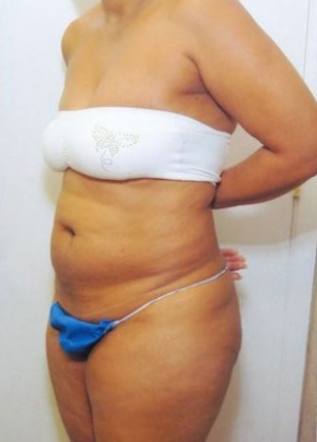 Tummy Tuck NJ