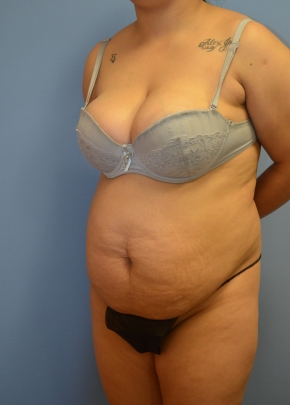 Tummy Tuck NJ