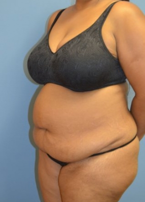 Tummy Tuck NJ