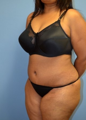 Tummy Tuck NJ