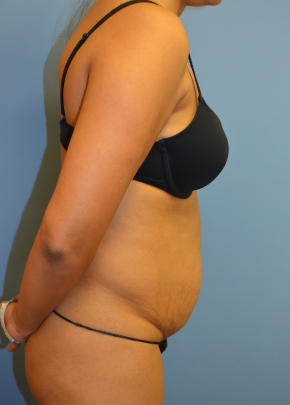 Tummy Tuck NJ