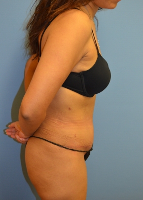 Tummy Tuck NJ