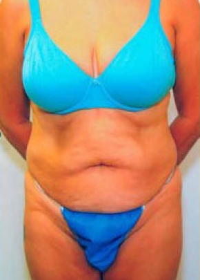 Tummy Tuck NJ