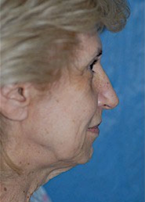 Facelift New Jersey