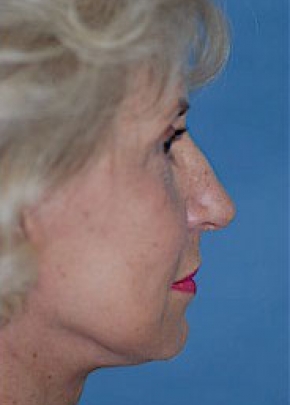 Facelift New Jersey