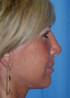 Facelift New Jersey