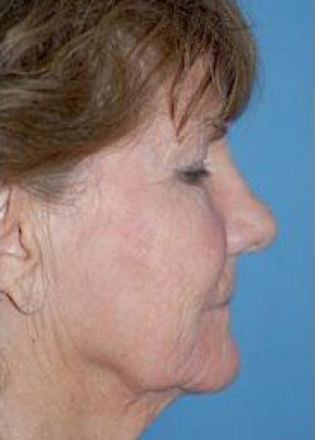 Facelift New Jersey