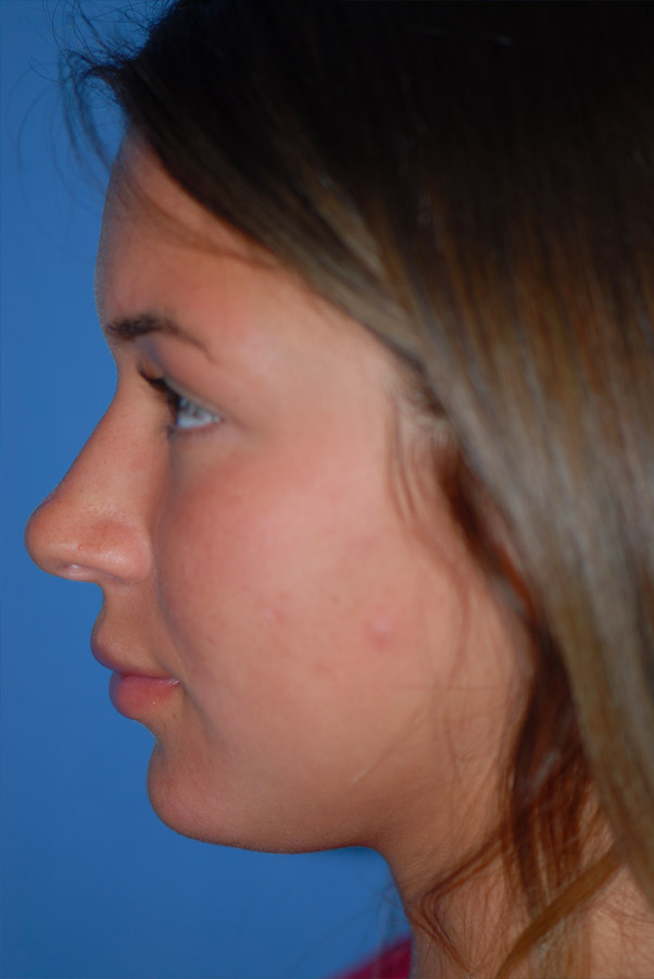 Rhinoplasty NJ