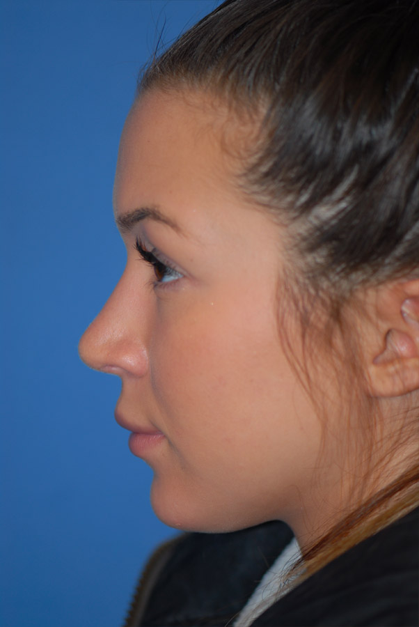 Rhinoplasty NJ