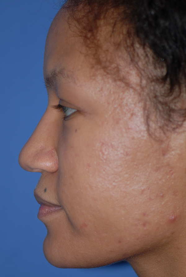 Rhinoplasty NJ