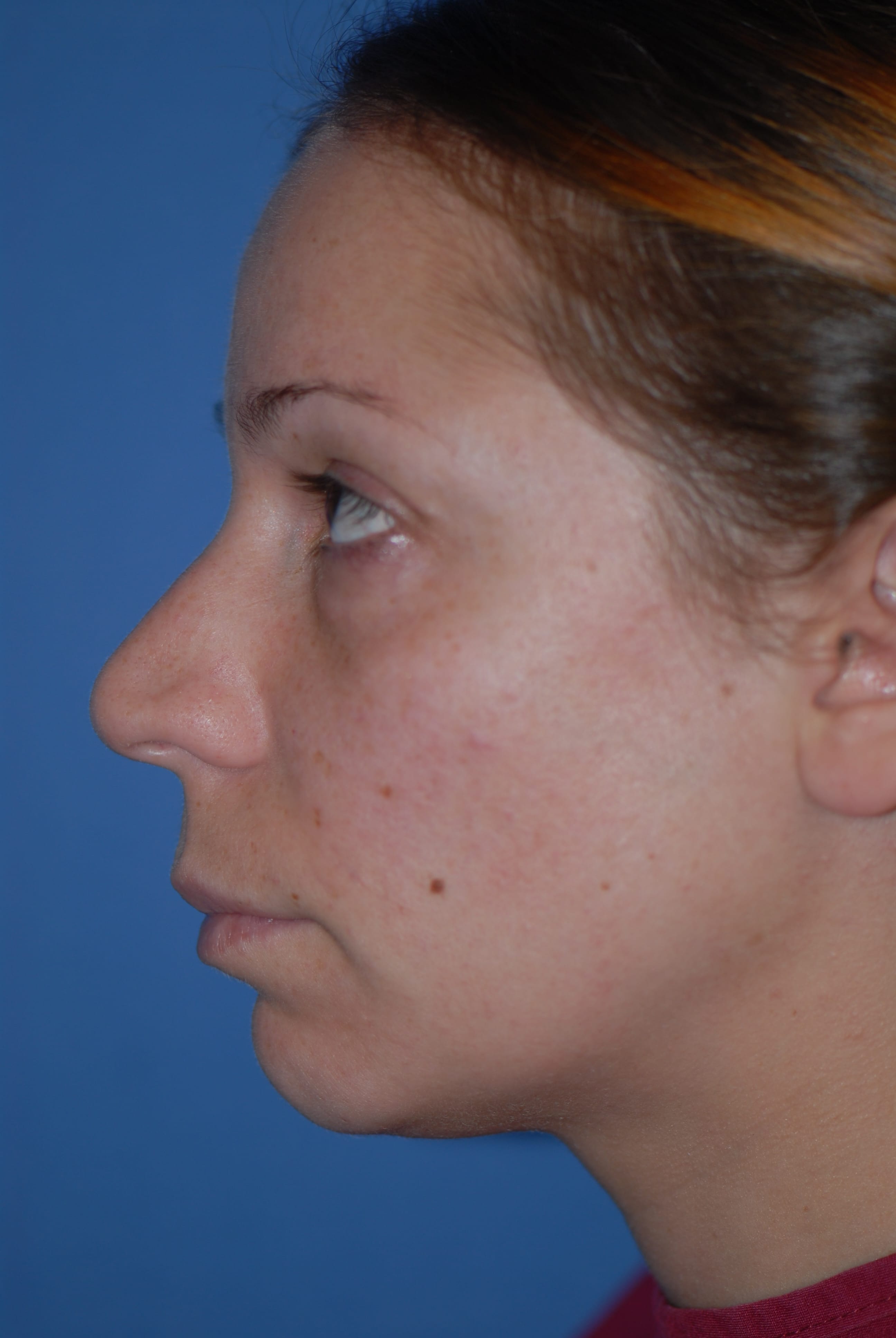 Rhinoplasty NJ
