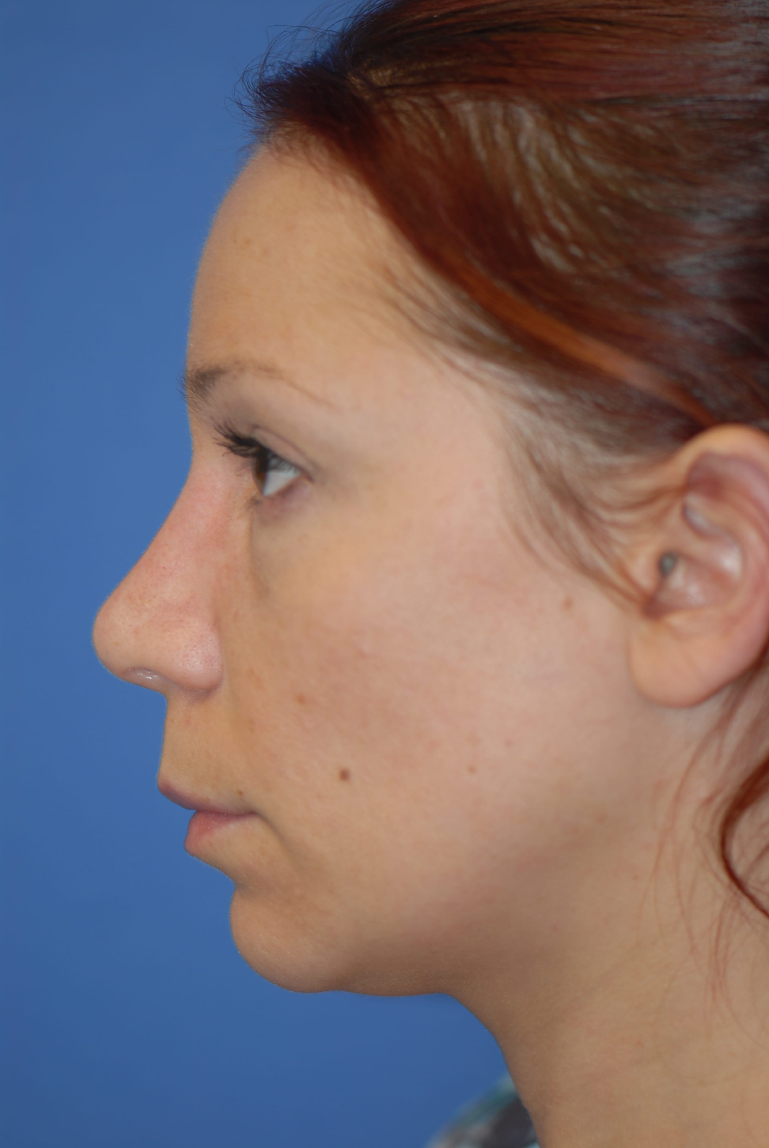 Rhinoplasty NJ
