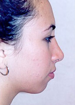 Rhinoplasty NJ