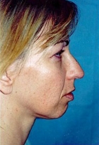 Rhinoplasty NJ