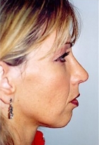 Rhinoplasty NJ