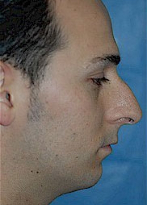 Rhinoplasty NJ
