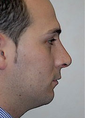 Rhinoplasty NJ