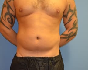 Abdominal Etching Before & After Photos | Associates in Plastic Surgery