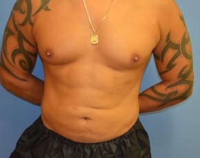 Abdominal Etching Before & After Photos | Associates in Plastic Surgery