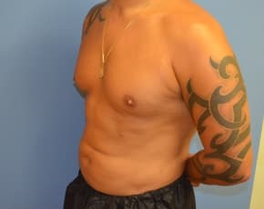 Abdominal Etching Before & After Photos | Associates in Plastic Surgery