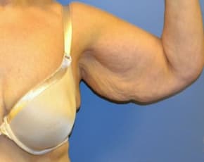 Arm Lift Before & After Photos | Associates in Plastic Surgery