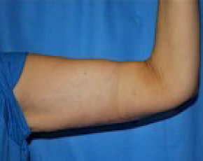 Arm Lift Before & After Photos | Associates in Plastic Surgery