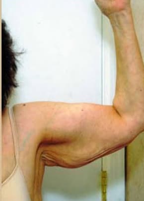 Arm Lift Before & After Photos | Associates in Plastic Surgery