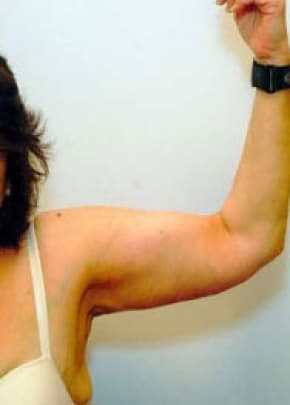 Arm Lift Before & After Photos | Associates in Plastic Surgery