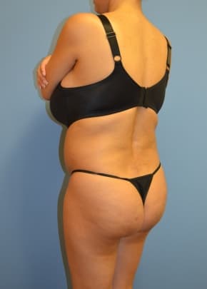 Brazilian Butt Lift Before & After Photos | Associates in Plastic Surgery