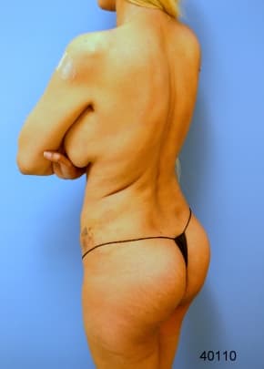 Buttocks Implants Before & After Photos | Associates in Plastic Surgery