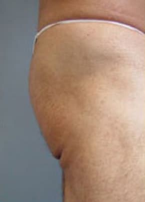 Buttocks Implants Before & After Photos | Associates in Plastic Surgery