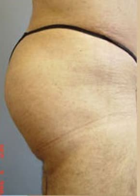 Buttocks Implants Before & After Photos | Associates in Plastic Surgery