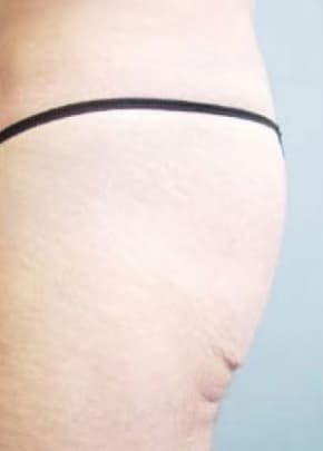 Buttocks Implants Before & After Photos | Associates in Plastic Surgery
