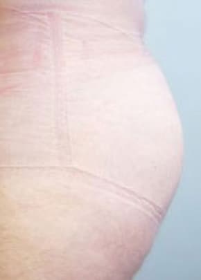 Buttocks Implants Before & After Photos | Associates in Plastic Surgery