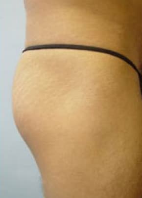Buttocks Implants Before & After Photos | Associates in Plastic Surgery