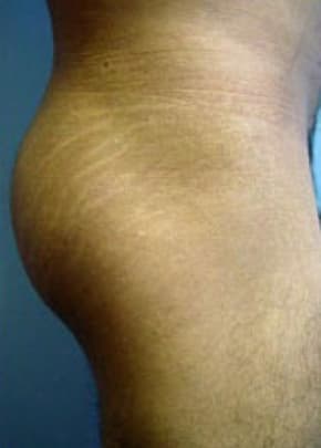 Buttocks Implants Before & After Photos | Associates in Plastic Surgery