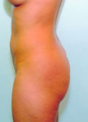 Buttocks Implants Before & After Photos | Associates in Plastic Surgery