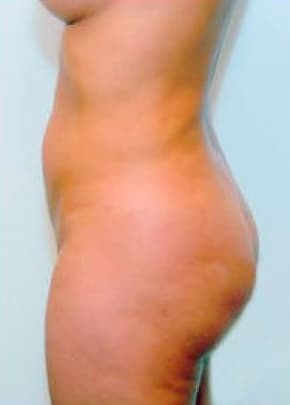 Buttocks Implants Before & After Photos | Associates in Plastic Surgery