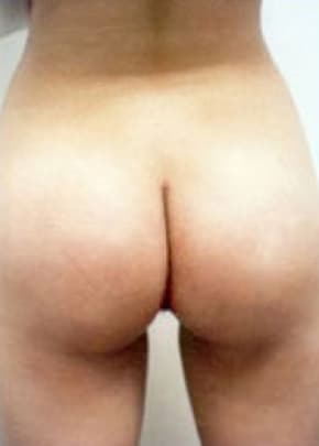 Buttocks Implants Before & After Photos | Associates in Plastic Surgery