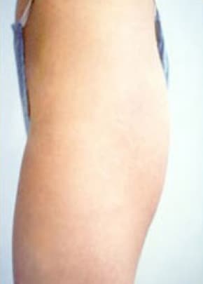 Buttocks Implants Before & After Photos | Associates in Plastic Surgery
