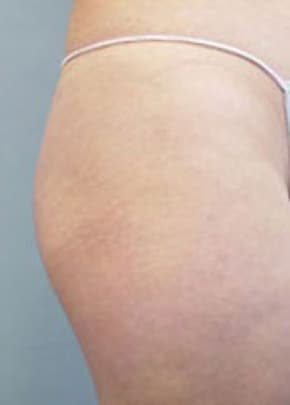 Buttocks Implants Before & After Photos | Associates in Plastic Surgery