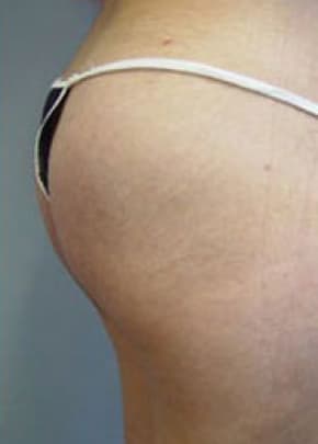 Buttocks Implants Before & After Photos | Associates in Plastic Surgery