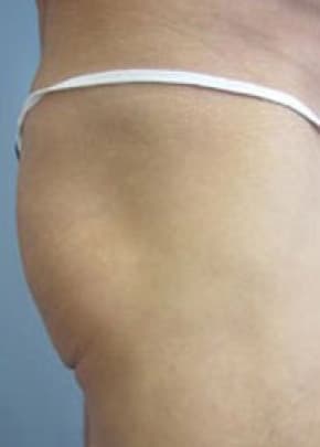 Buttocks Implants Before & After Photos | Associates in Plastic Surgery